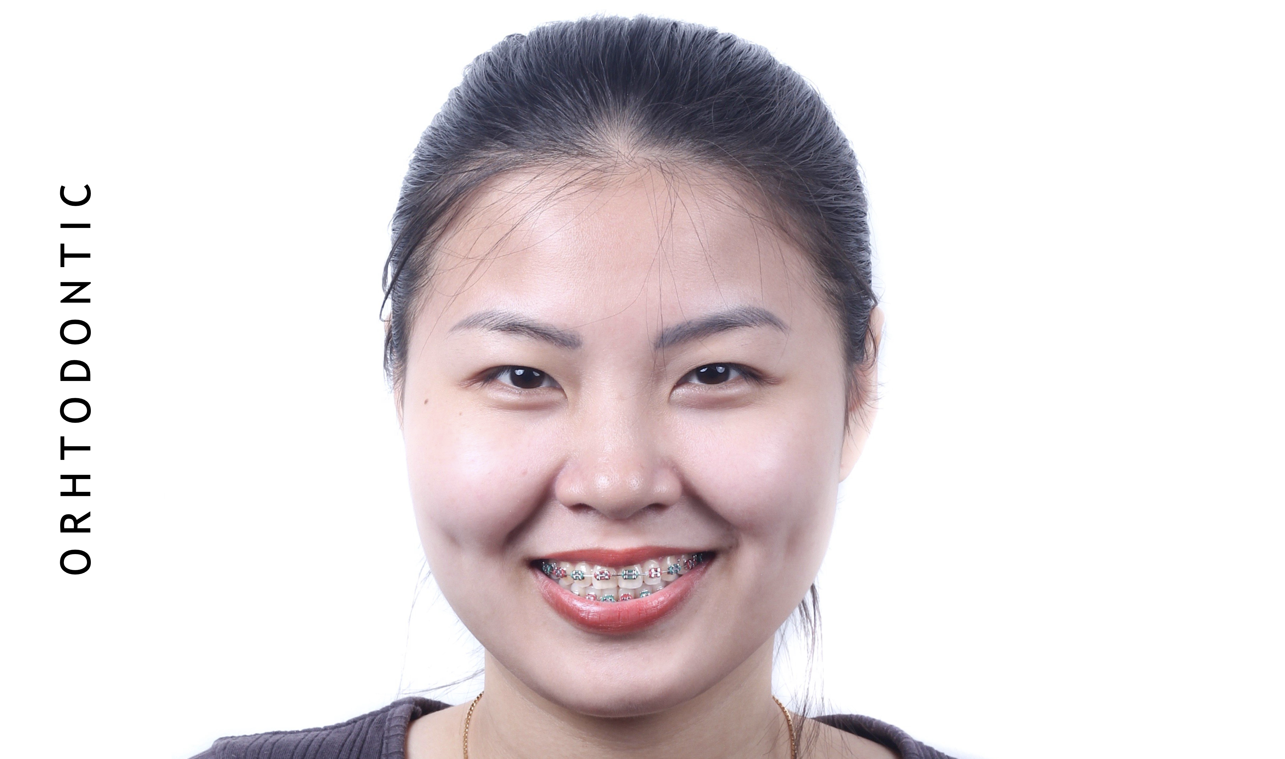 Orthodontics Treatment